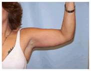Image for Arm Lift