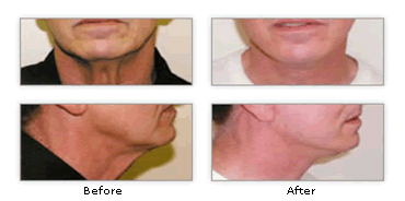Image for Before After NeckLift Surgery