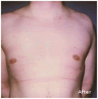 Image for Before After Gynecomastia